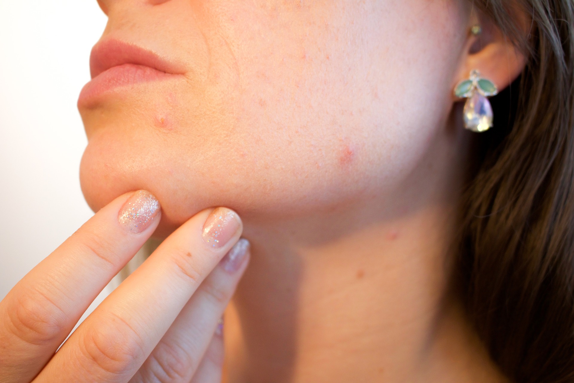 Le cure antiacne dall'adolescenza agli "anta"